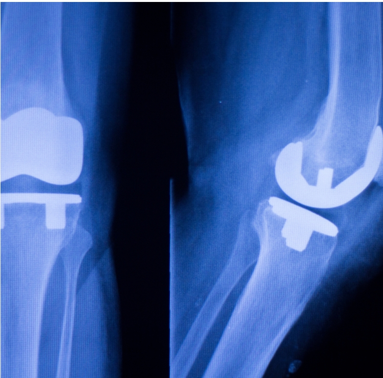 Joint Replacement Surgeries
