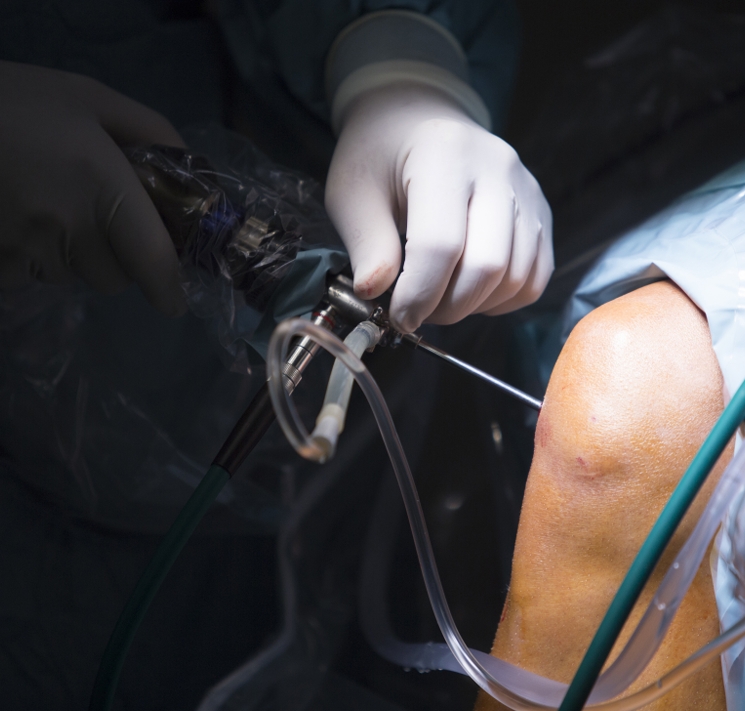 Arthroscopic Surgeries